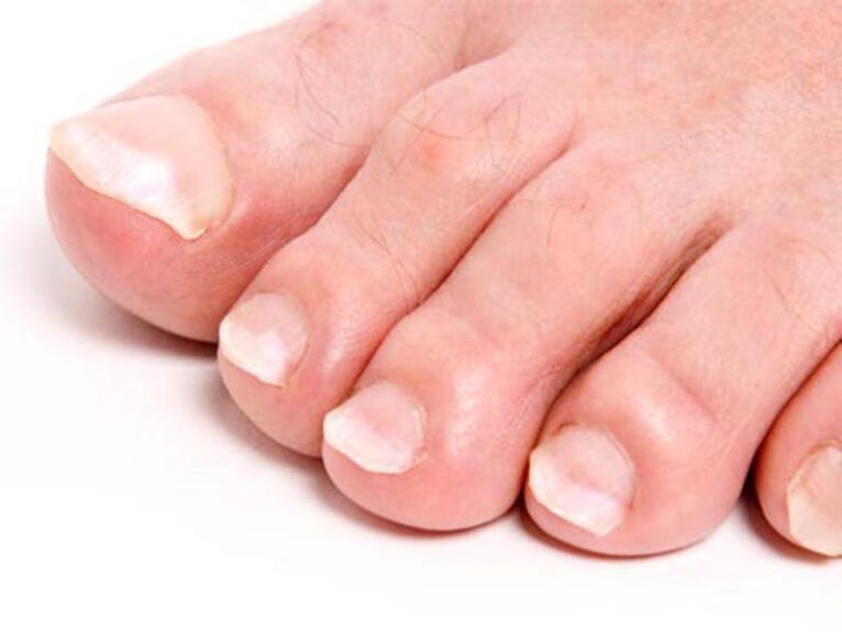 Toenail fungus and its treatment