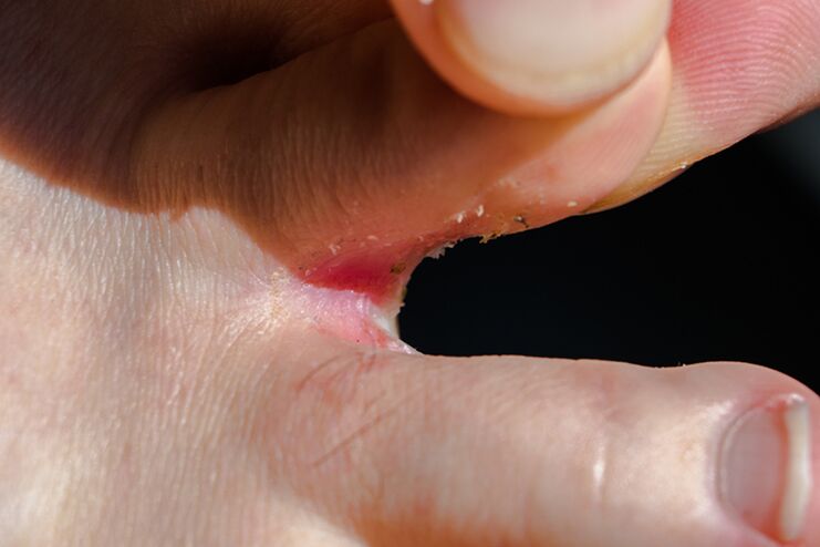Tricophitosis