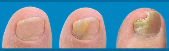 Stages of fungal development