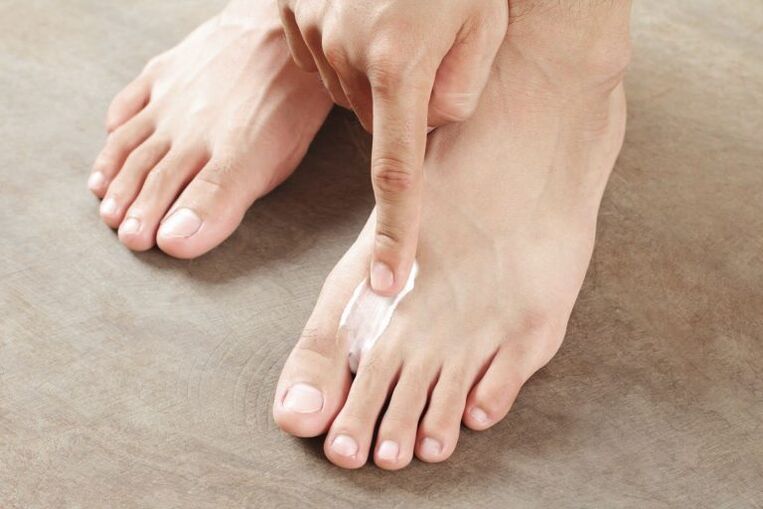 Applying antifungal cream to the skin of the foot