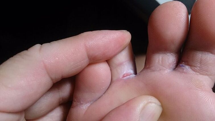 Fungi between fingers