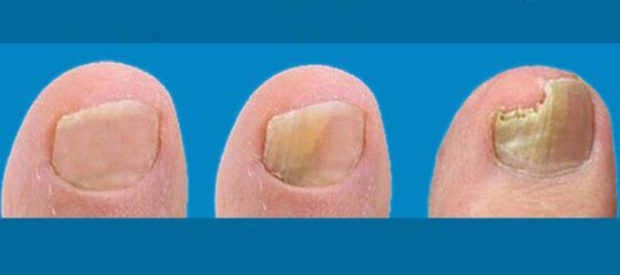 The stages of nail fungus