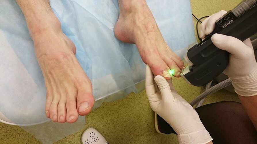 Laser treatment of nail fungus