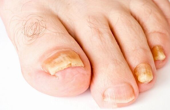 Nail mushroom shapes