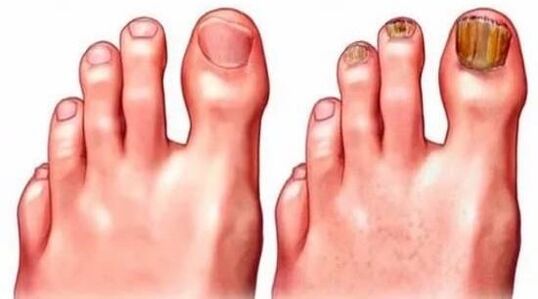 Healthy nails and nails affected by fungi