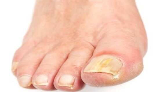 Nail breakdown due to fungal infection