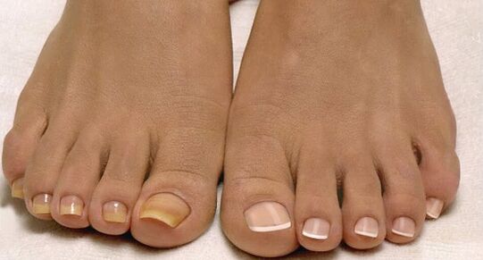 normal nails and fungi of the toes