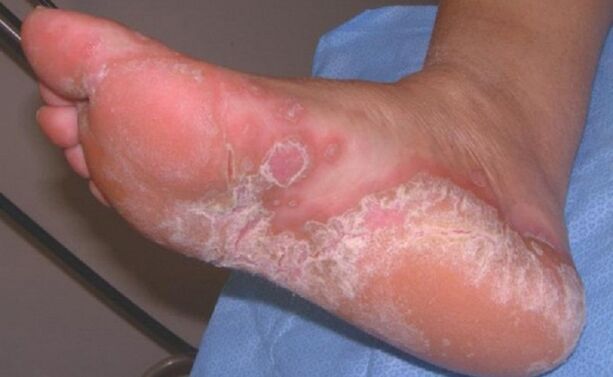 foot mold symptoms