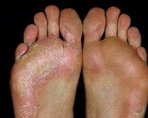 fungal foot lesions