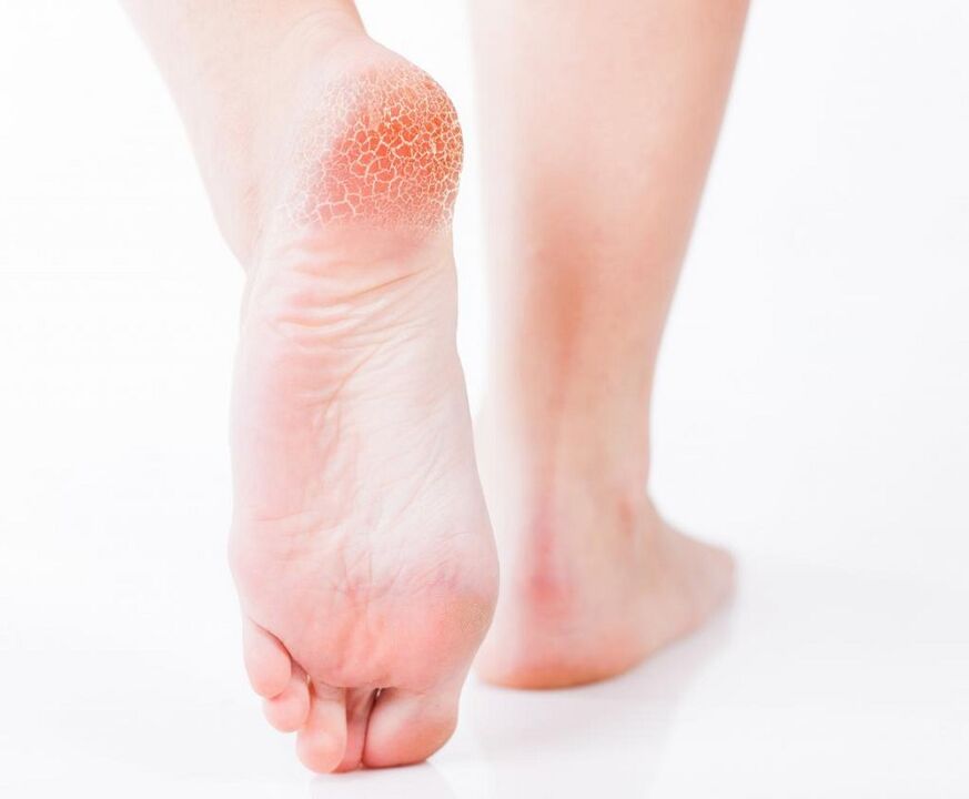 foot fungal infection