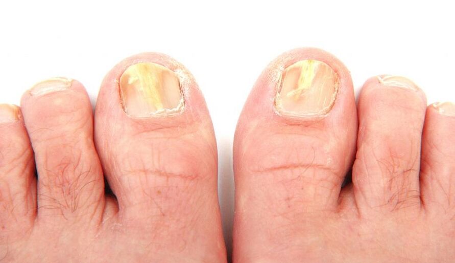 toenail fungus