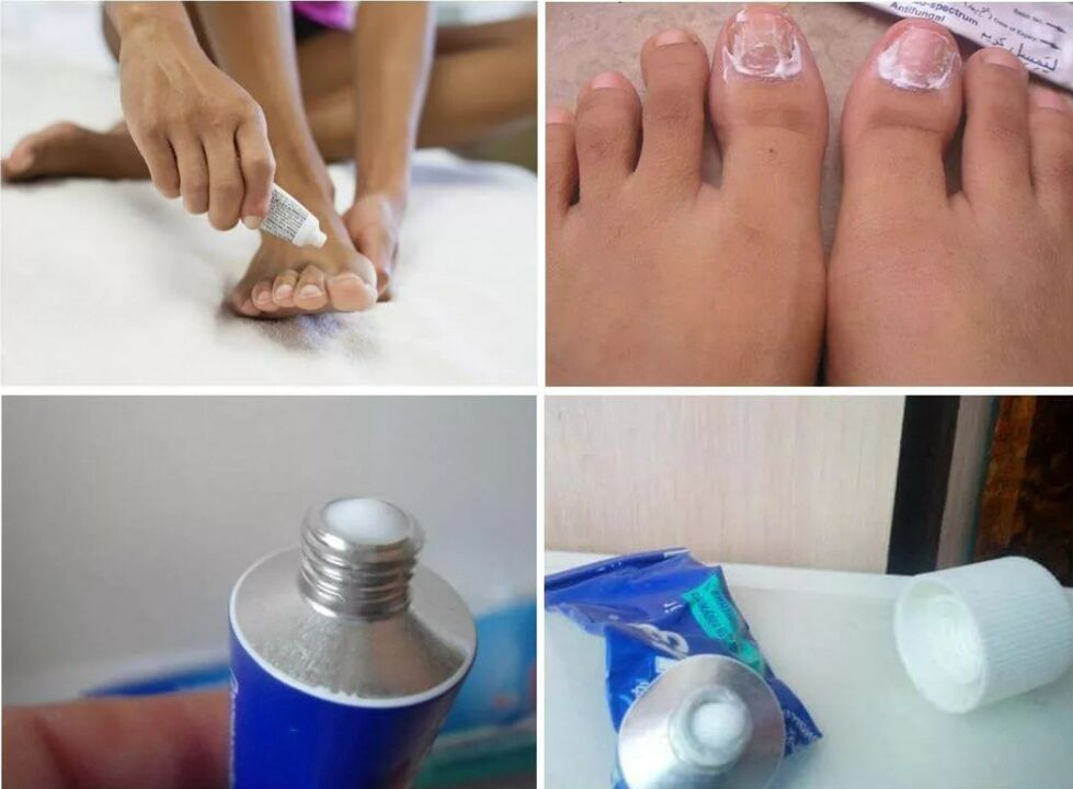 remedy for nail fungus
