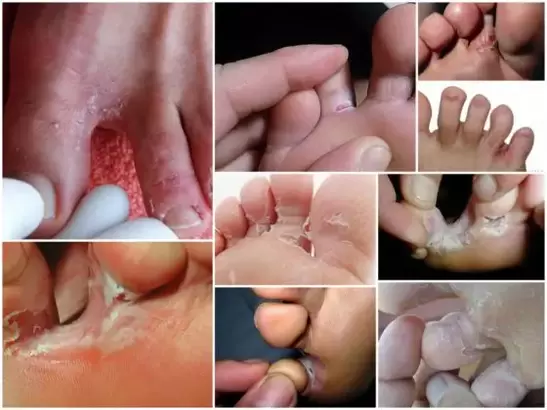 symptoms of fungus between the fingers photo 2