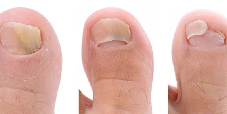 picture of nail fungus