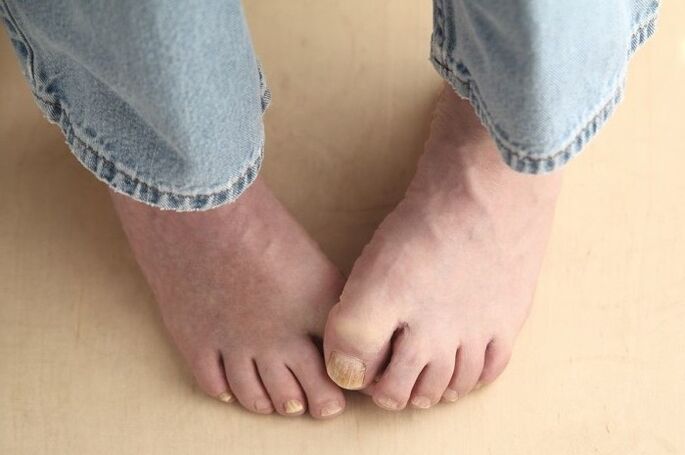 Feet with nails affected by mold