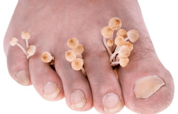 Fungal infection on foot