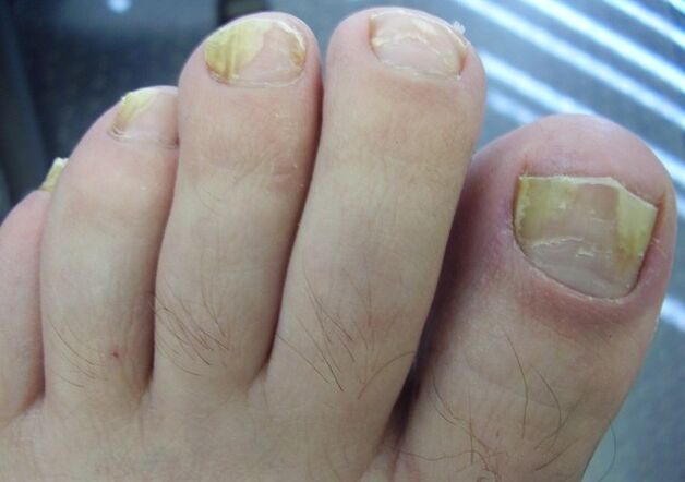 Fungal toenails