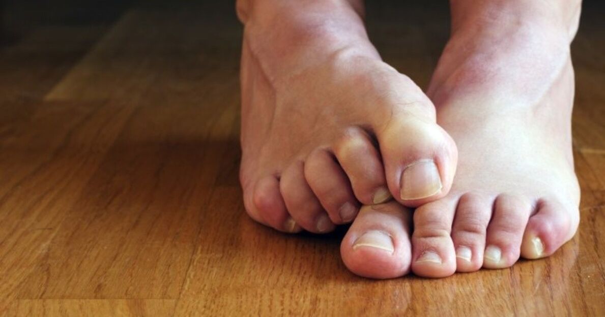 symptoms of fungus between the toes